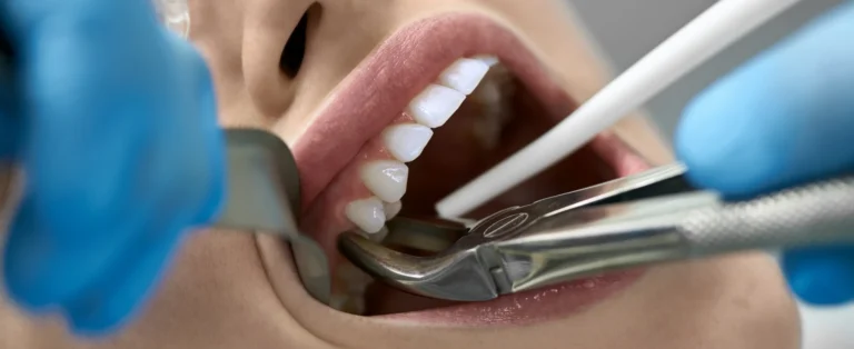 Extraction dent de sagesse