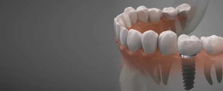 Extraction implantation immédiate